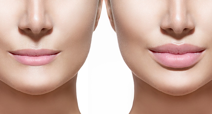 lip-fillers-med-spa-Columbus-Ohio
