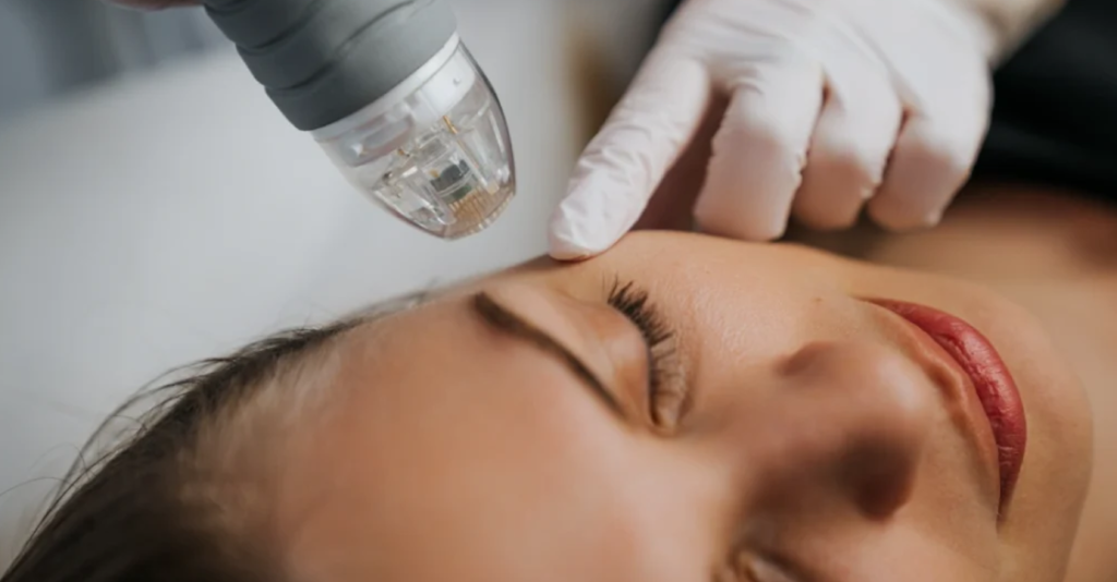 Microneedling-With-Exosomes